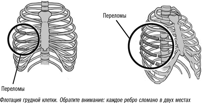 Перелом ребер - Травмы; отравления - Справочник MSD Профессиональная версия