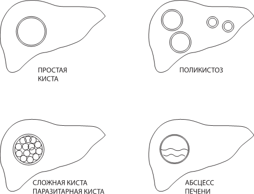 Удаление капсулы кисты печени методом лапароскопии