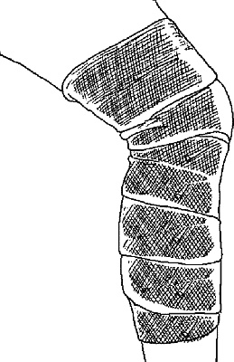 Иллюстрация к книге — Варикозное расширение вен. Лечение традиционными и нетрадиционными методами [_07.jpg]