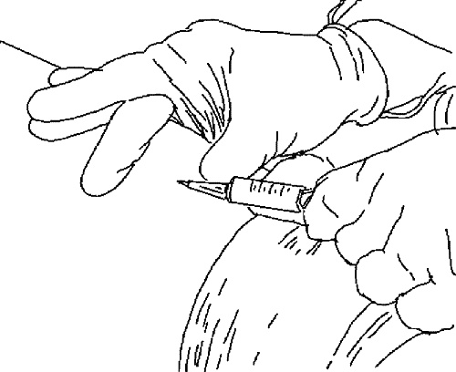 Иллюстрация к книге — Варикозное расширение вен. Лечение традиционными и нетрадиционными методами [_23.jpg]