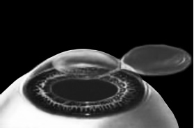 Иллюстрация к книге — Лазерная коррекция зрения [i_005.jpg]