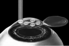 Иллюстрация к книге — Лазерная коррекция зрения [i_006.jpg]