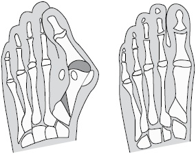 Иллюстрация к книге — Плоскостопие. Самые эффективные методы лечения [Autogen_eBook_id32.jpg]