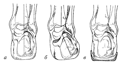 Иллюстрация к книге — Плоскостопие. Легкая походка - здоровый позвоночник [Autogen_eBook_id11.jpg]