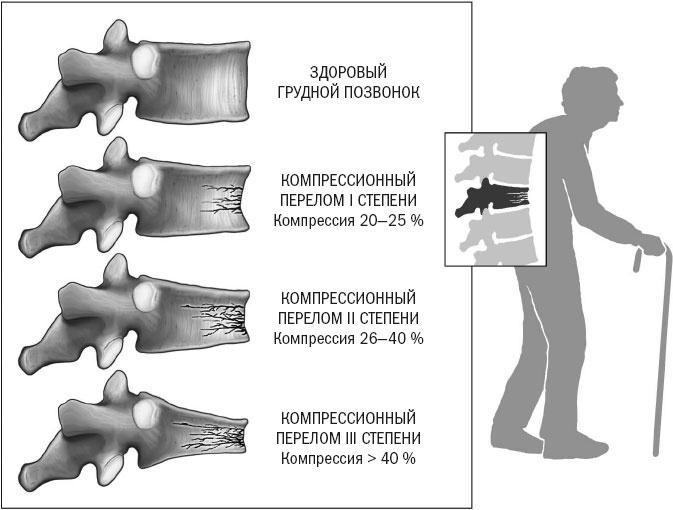 Иллюстрация к книге — Йога при остеопорозе [_1.jpg]