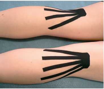 Иллюстрация к книге — Кинезиотейпинг в лечебной практике неврологии и ортопедии [i_036.jpg]