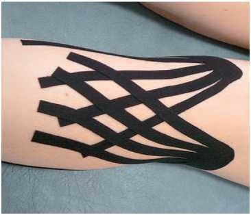 Иллюстрация к книге — Кинезиотейпинг в лечебной практике неврологии и ортопедии [i_037.jpg]