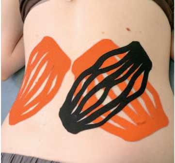 Иллюстрация к книге — Кинезиотейпинг в лечебной практике неврологии и ортопедии [i_039.jpg]