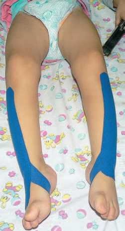 Иллюстрация к книге — Кинезиотейпинг в лечебной практике неврологии и ортопедии [i_091.jpg]