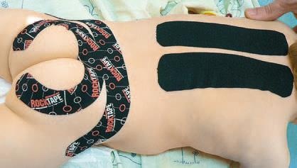 Иллюстрация к книге — Кинезиотейпинг в лечебной практике неврологии и ортопедии [i_094.jpg]