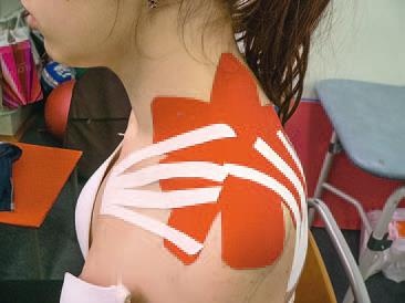 Иллюстрация к книге — Кинезиотейпинг в лечебной практике неврологии и ортопедии [i_148.jpg]