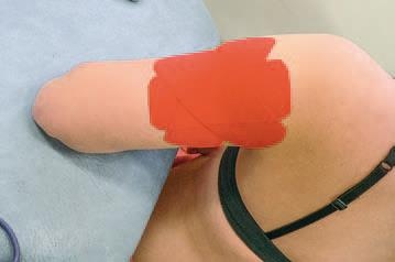 Иллюстрация к книге — Кинезиотейпинг в лечебной практике неврологии и ортопедии [i_151.jpg]