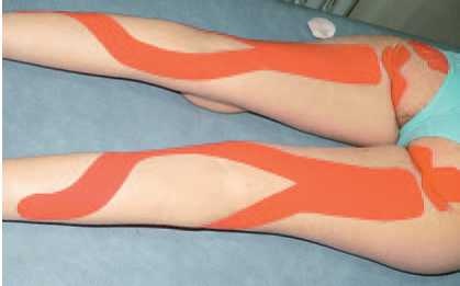 Иллюстрация к книге — Кинезиотейпинг в лечебной практике неврологии и ортопедии [i_187.jpg]