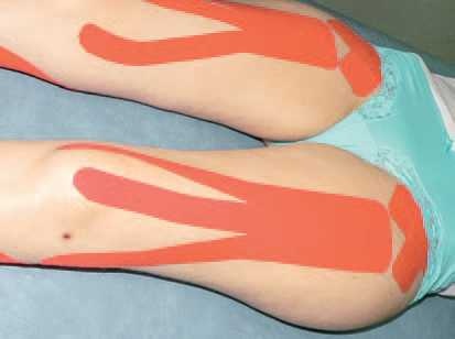 Иллюстрация к книге — Кинезиотейпинг в лечебной практике неврологии и ортопедии [i_188.jpg]