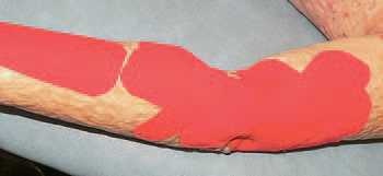 Иллюстрация к книге — Кинезиотейпинг в лечебной практике неврологии и ортопедии [i_232.jpg]