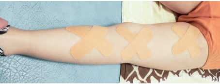 Иллюстрация к книге — Кинезиотейпинг в лечебной практике неврологии и ортопедии [i_278.jpg]