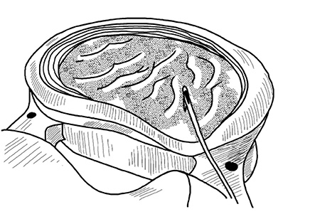 Иллюстрация к книге — Жизнь без боли в спине. Лечение сколиоза, остеопороза, остеохондроза, межпозвонковой грыжи без операции [i_073.jpg]