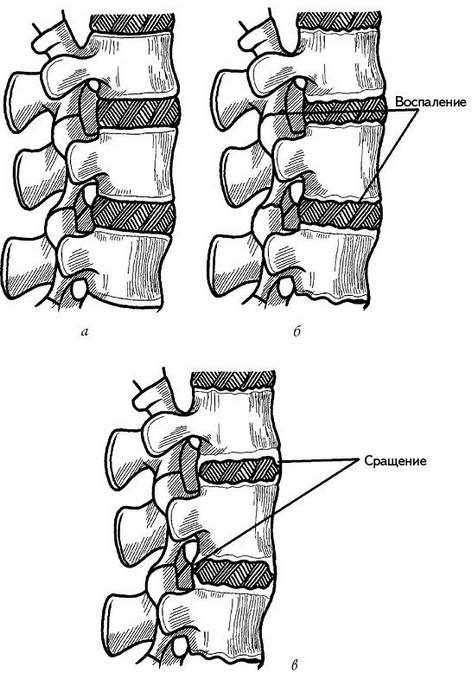 Иллюстрация к книге — Жизнь без боли в спине. Лечение сколиоза, остеопороза, остеохондроза, межпозвонковой грыжи без операции [i_123.jpg]