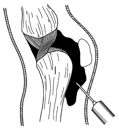 Иллюстрация к книге — Жизнь без боли в спине. Лечение сколиоза, остеопороза, остеохондроза, межпозвонковой грыжи без операции [i_161.jpg]