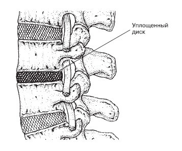 Иллюстрация к книге — Боль в спине. Как определить причину и устранить приступ [i_003.jpg]