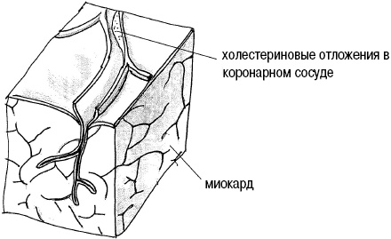 Иллюстрация к книге — Стоп-инфаркт. Как читать ЭКГ и заботиться о сердце [autogen_ebook_id23.jpg]