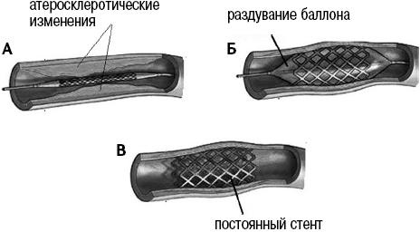 Иллюстрация к книге — Стоп-инфаркт. Как читать ЭКГ и заботиться о сердце [autogen_ebook_id26.jpg]