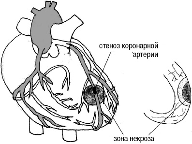 Иллюстрация к книге — Стоп-инфаркт. Как читать ЭКГ и заботиться о сердце [autogen_ebook_id28.jpg]