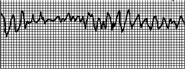 Иллюстрация к книге — Стоп-инфаркт. Как читать ЭКГ и заботиться о сердце [autogen_ebook_id9.jpg]