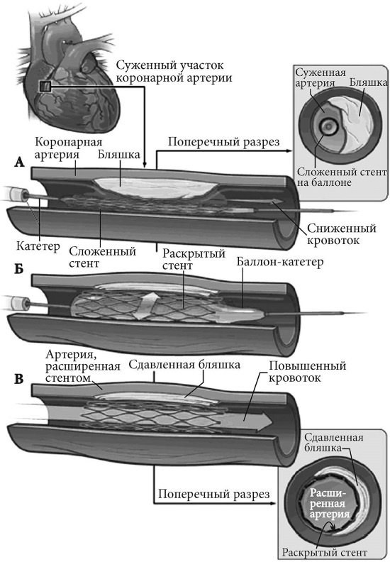Иллюстрация к книге — Лучшие методы лечения и профилактики инфаркта миокарда [i_014.jpg]