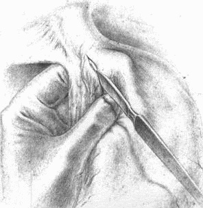 Иллюстрация к книге — Этюды желудочной хирургии [i_033.jpg]