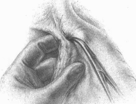 Иллюстрация к книге — Этюды желудочной хирургии [i_034.jpg]