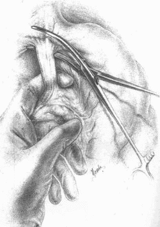 Иллюстрация к книге — Этюды желудочной хирургии [i_036.jpg]