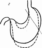 Иллюстрация к книге — Этюды желудочной хирургии [i_040.jpg]