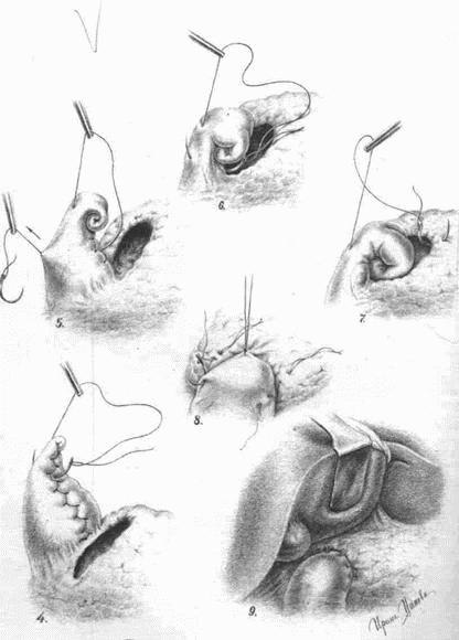 Иллюстрация к книге — Этюды желудочной хирургии [i_045.jpg]