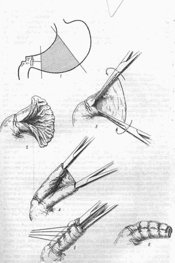 Иллюстрация к книге — Этюды желудочной хирургии [i_046.jpg]