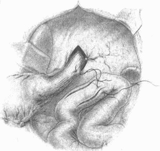 Иллюстрация к книге — Этюды желудочной хирургии [i_104.jpg]