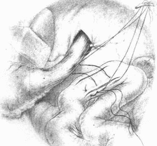 Иллюстрация к книге — Этюды желудочной хирургии [i_105.jpg]