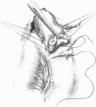 Иллюстрация к книге — Этюды желудочной хирургии [i_109.jpg]