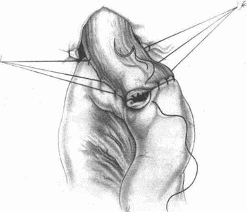 Иллюстрация к книге — Этюды желудочной хирургии [i_111.jpg]