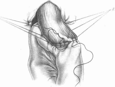 Иллюстрация к книге — Этюды желудочной хирургии [i_112.jpg]