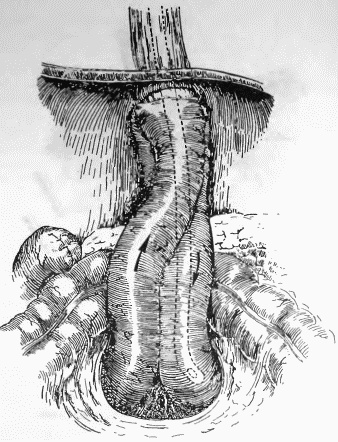 Иллюстрация к книге — Этюды желудочной хирургии [i_116.jpg]