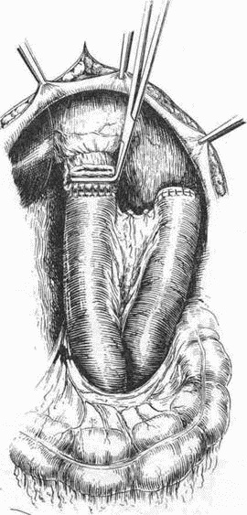 Иллюстрация к книге — Этюды желудочной хирургии [i_117.jpg]