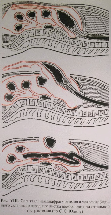 Иллюстрация к книге — Этюды желудочной хирургии [i_136.jpg]