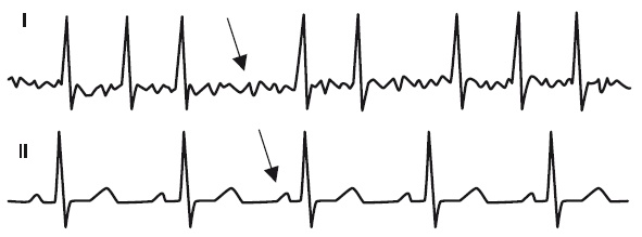 Иллюстрация к книге — Что показывает кардиограмма [i_041.jpg]
