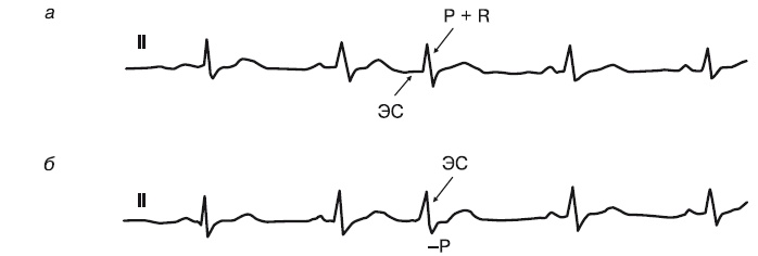 Иллюстрация к книге — Что показывает кардиограмма [i_046.jpg]