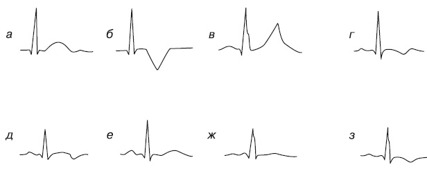 Иллюстрация к книге — Что показывает кардиограмма [i_050.jpg]