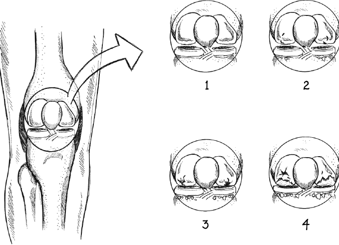 Иллюстрация к книге — Колени. Как у вас дела? Как ухаживать за одним из самых уязвимых суставов и не пропустить проблемы [i_010.jpg]