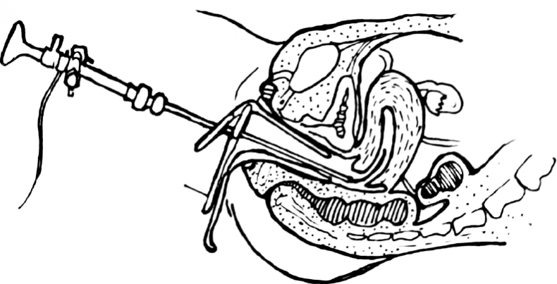 Иллюстрация к книге — 1000 вопросов и ответов по гинекологии [_57.jpg]