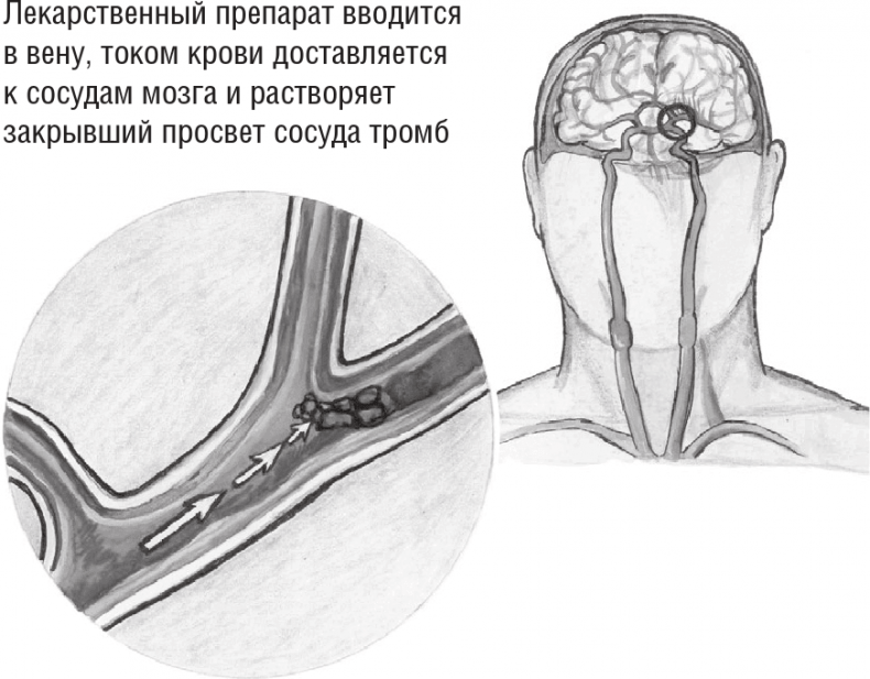 Иллюстрация к книге — Хрупкий мозг. Инсульту не быть? [img_31.jpg]