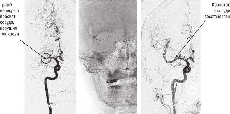 Иллюстрация к книге — Хрупкий мозг. Инсульту не быть? [img_34.jpg]